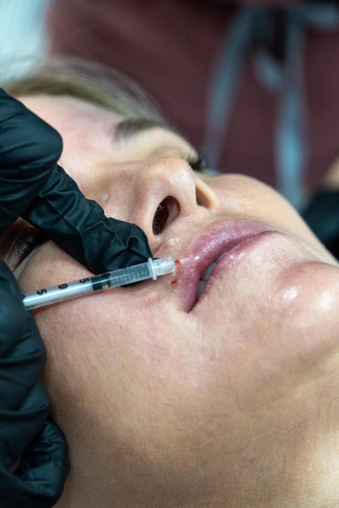 Stock photo — patient receiving a lip filler injection
