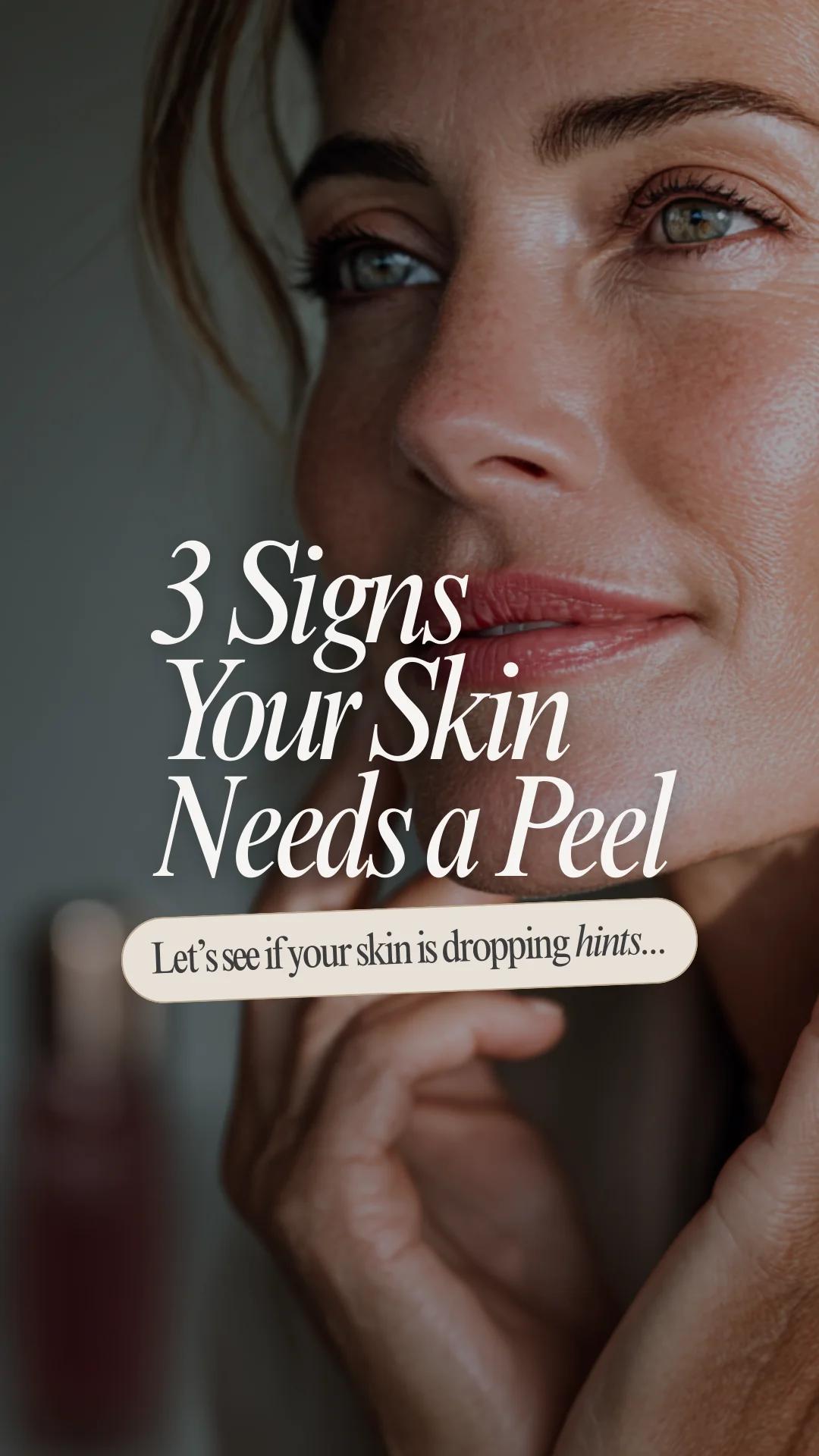 Esthetician template — 3 signs your skin needs a peel